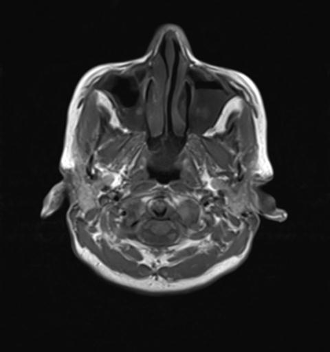 File:Autoimmune limbic encephalitis (Radiopaedia 30363-31005 Axial T1 2).jpg
