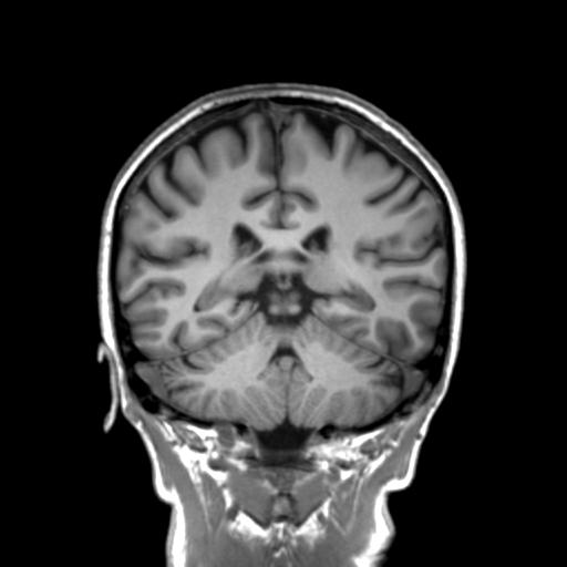 Autoimmune limbic encephalitis (Radiopaedia 30363-31005 Coronal T1 23).jpg