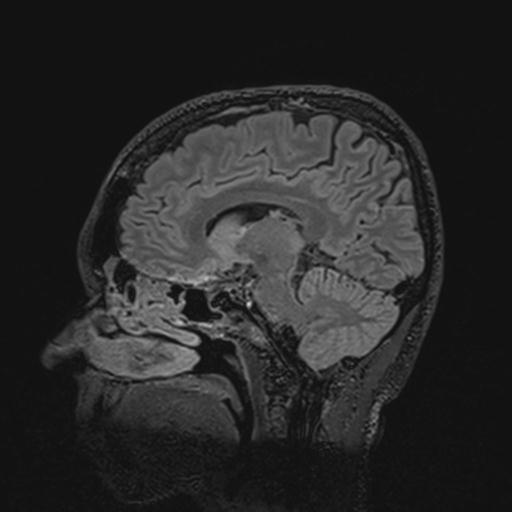 Autoimmune limbic encephalitis (Radiopaedia 30363-31005 Sagittal FLAIR 72).jpg