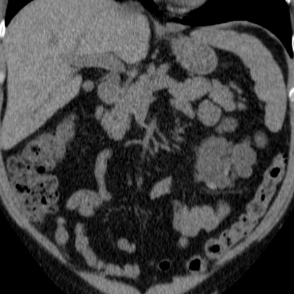 File:Autosomal dominant polycystic kidney disease (Radiopaedia 36539-38101 Coronal non-contrast 9).jpg