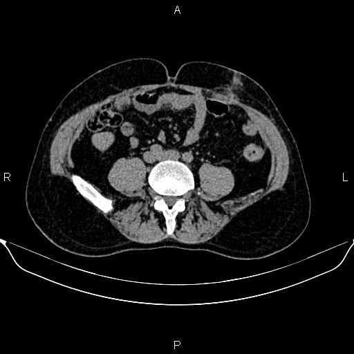 Autosomal dominant polycystic kidney disease (Radiopaedia 87830-104287 Axial non-contrast 36).jpg