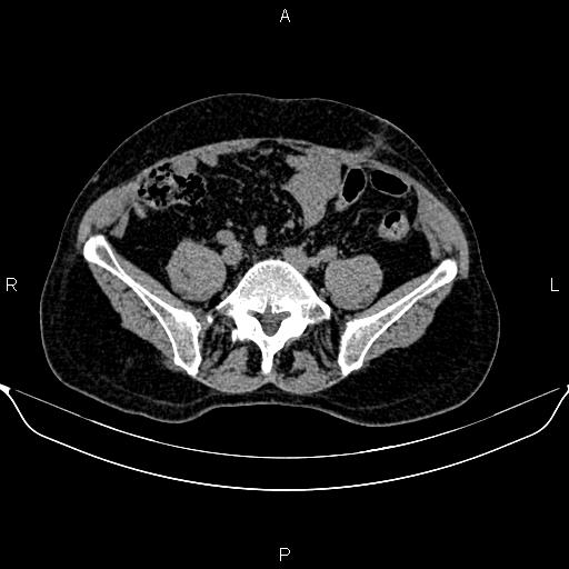 Autosomal dominant polycystic kidney disease (Radiopaedia 87830-104287 Axial non-contrast 39).jpg