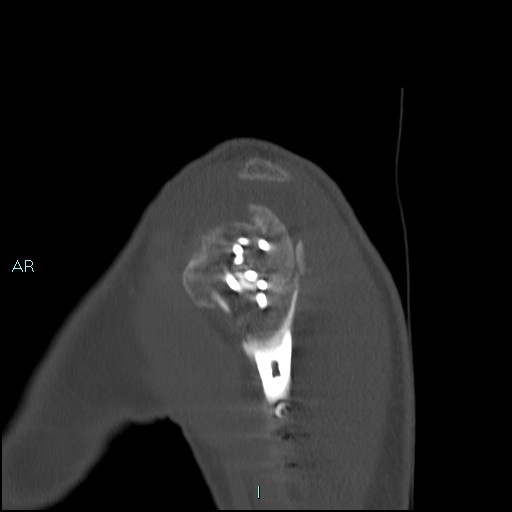 Avascular necrosis after fracture dislocations of the proximal humerus (Radiopaedia 88078-104653 Sagittal bone window 18).jpg
