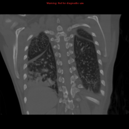 Avascular necrosis in sickle cell disease (Radiopaedia 17448-17152 Coronal bone window 101).jpg