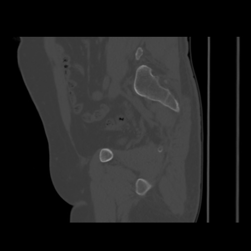 Avascular necrosis of the hip (Radiopaedia 61503-69467 B 23).jpg