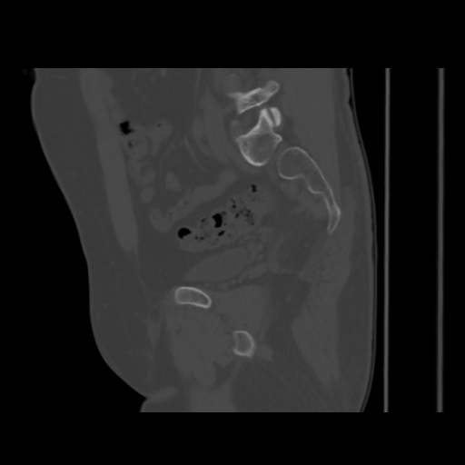 Avascular necrosis of the hip (Radiopaedia 61503-69467 B 25).jpg