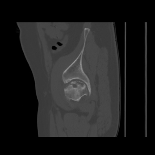 Avascular necrosis of the hip (Radiopaedia 61503-69467 B 48).jpg