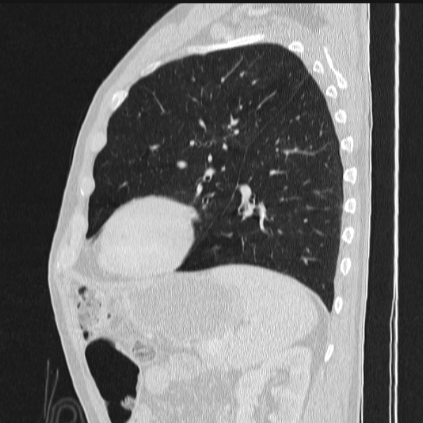 Azygos lobe (Radiopaedia 38259-40275 lung window 72).jpg