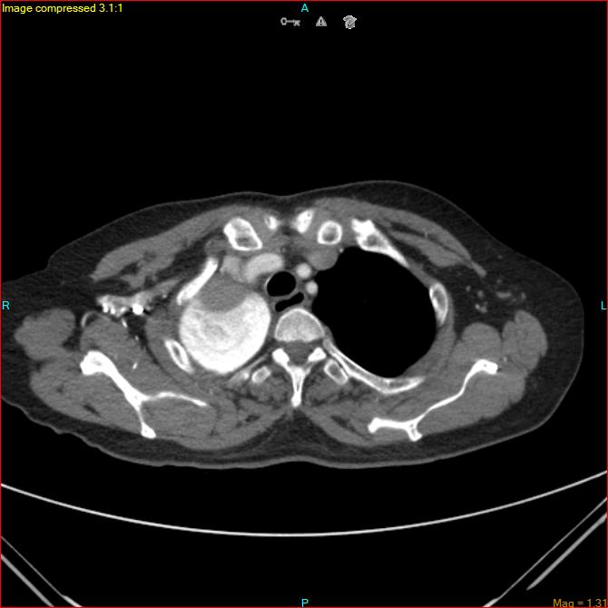 Azygos vein aneurysm (Radiopaedia 77824-90130 B 12).jpg