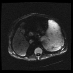 B cell lymphoma (Radiopaedia 56281-62954 Axial DWI 20).jpg