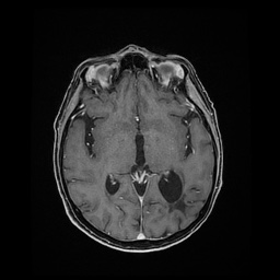 Balo concentric sclerosis (Radiopaedia 53875-59982 Axial LAVA C+ 130).jpg