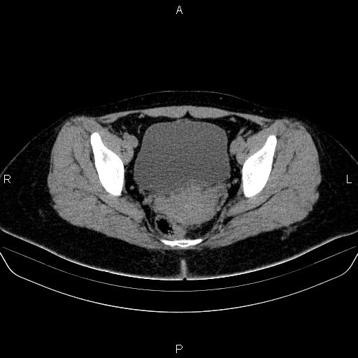 File:Bartholin gland cyst (Radiopaedia 62635-70930 Axial non-contrast 53).jpg