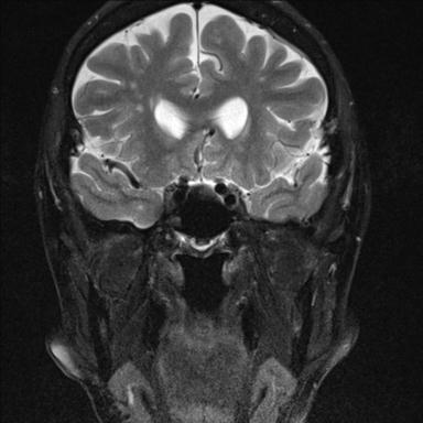 File:Base of skull chondrosarcoma (Radiopaedia 30410-31070 Coronal T2 fat sat 14).jpg