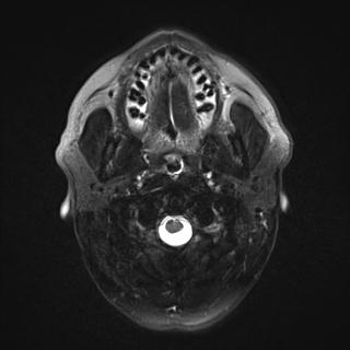 File:Base of tongue squamous cell carcinoma (Radiopaedia 31174-31884 Axial T2 fat sat 23).jpg