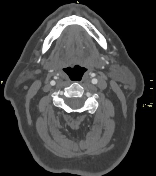 File:Basilar artery aneurysm (Radiopaedia 56261-62932 A 9).jpg
