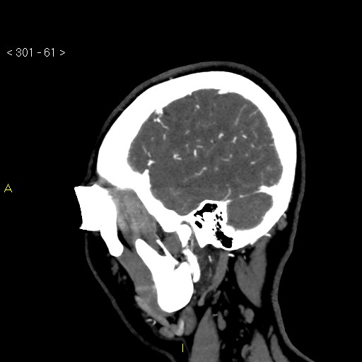 Basilar artery thrombosis (Radiopaedia 16260-15944 C 55).jpg