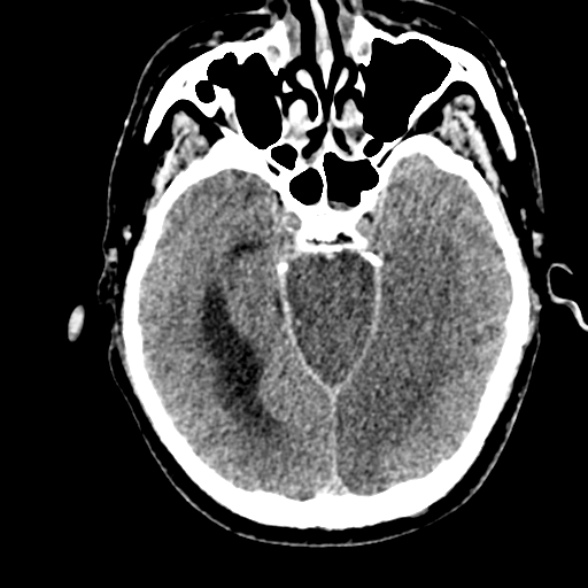 Basilar artery thrombosis (Radiopaedia 53351-59352 Axial non-contrast 47).jpg
