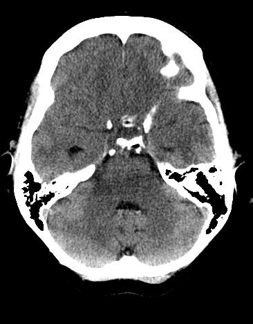 File:Basilar tip aneurysm with coiling (Radiopaedia 53912-60033 Axial non-contrast 8).jpg