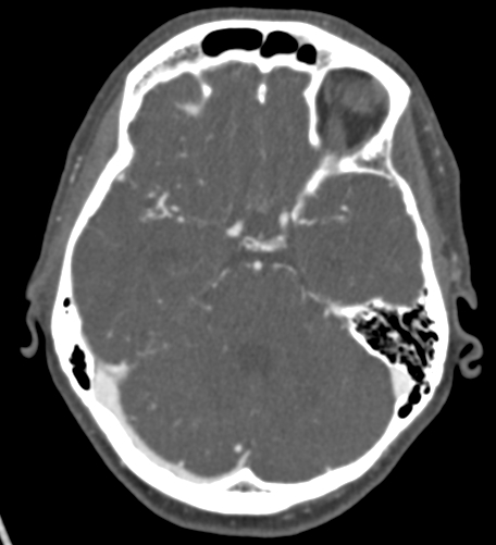 File:Basilar tip aneurysm with coiling (Radiopaedia 53912-60086 A 52).jpg