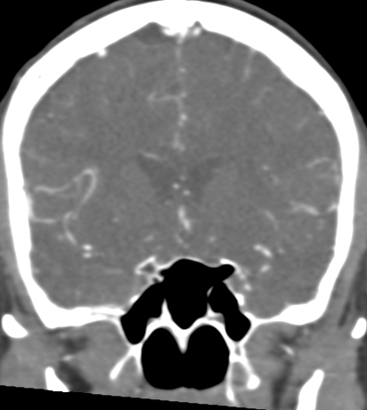 Basilar tip aneurysm with coiling (Radiopaedia 53912-60086 B 53).jpg
