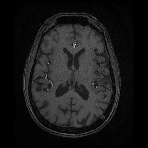 Basilar top and left middle cerebral artery aneurysm (Radiopaedia 61965-70031 Axial MRA 96).jpg