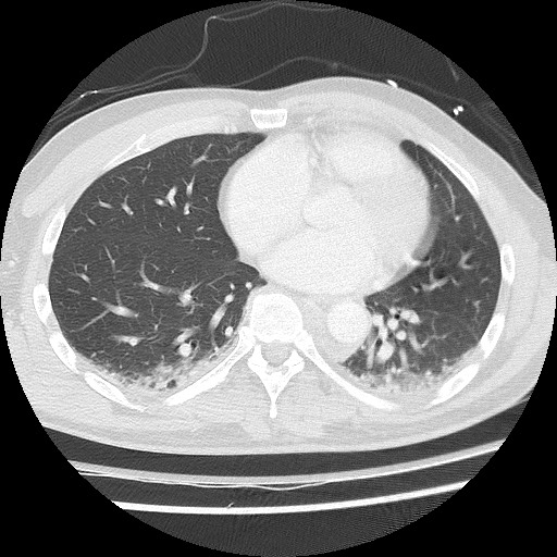Benign post-traumatic pseudopneumoperitoneum (Radiopaedia 71199-81495 Axial lung window 46).jpg