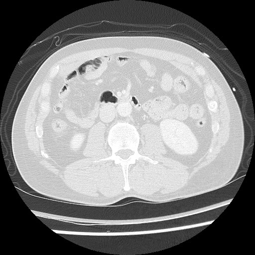 Benign post-traumatic pseudopneumoperitoneum (Radiopaedia 71199-81495 Axial lung window 89).jpg
