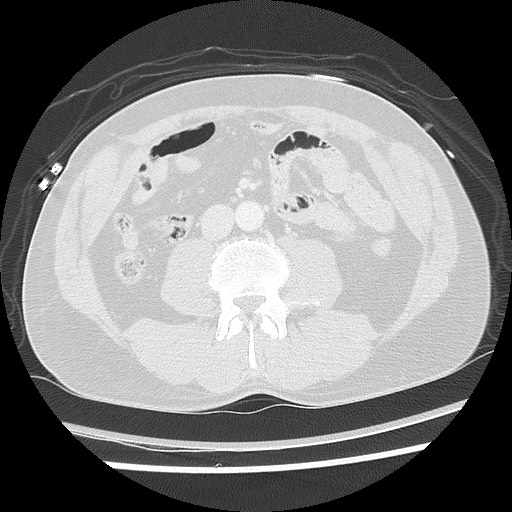 Benign post-traumatic pseudopneumoperitoneum (Radiopaedia 71199-81495 Axial lung window 94).jpg