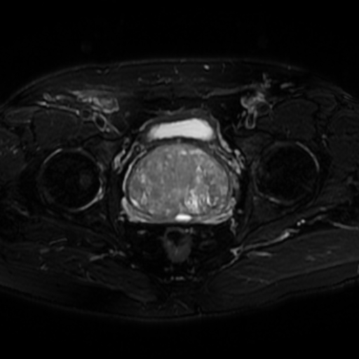File:Benign prostatic nodular hyperplasia (Radiopaedia 16917-16634 Axial T2 fat sat 8).jpg
