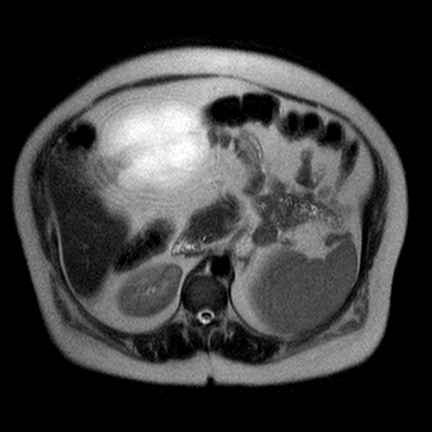 File:Benign seromucinous cystadenoma of the ovary (Radiopaedia 71065-81300 Axial T2 12).jpg