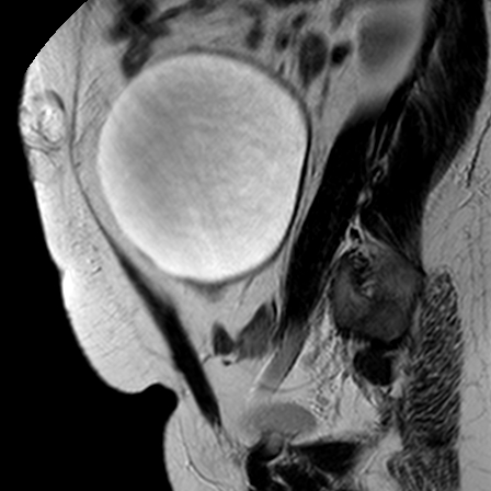 File:Benign seromucinous cystadenoma of the ovary (Radiopaedia 71065-81300 Sagittal T2 7).jpg