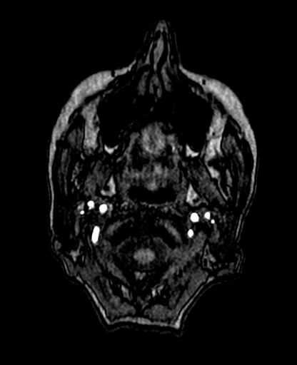 Berry aneurysm of the terminal internal carotid artery (Radiopaedia 88286-104918 Axial TOF 14).jpg