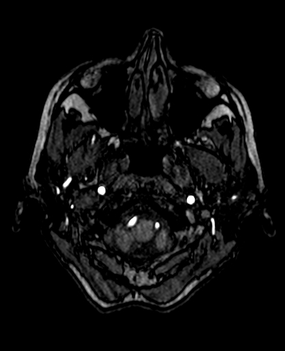 Berry aneurysm of the terminal internal carotid artery (Radiopaedia 88286-104918 Axial TOF 42).jpg