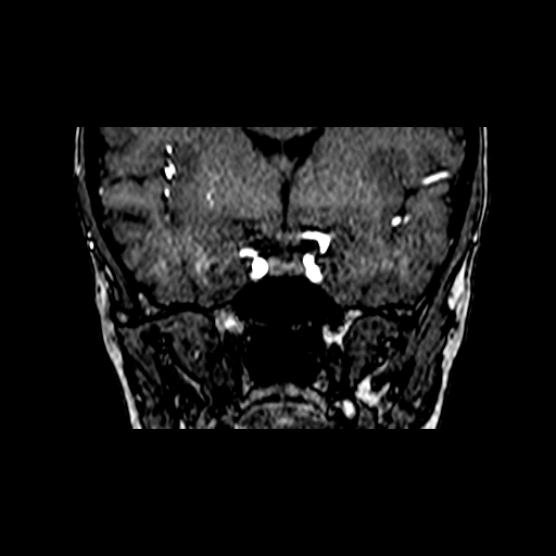 Berry aneurysm of the terminal internal carotid artery (Radiopaedia 88286-104918 Coronal TOF 38).jpg