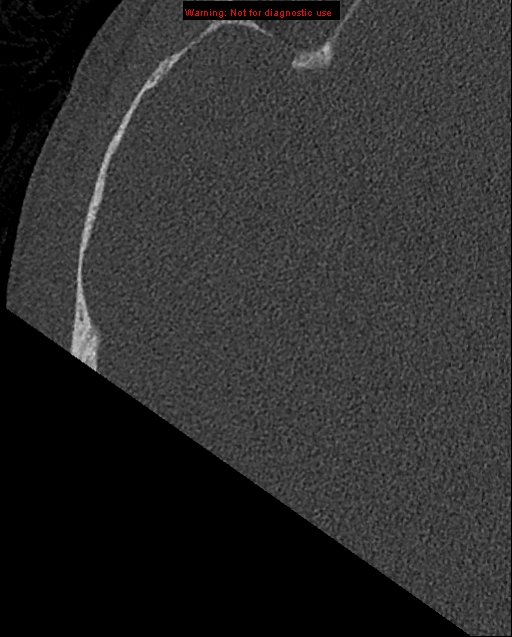 Bezold abscess (Radiopaedia 21645-21605 bone window 5).jpg