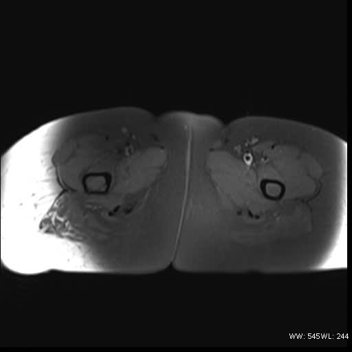 File:Bicornuate uterus- on MRI (Radiopaedia 49206-54297 Axial T1 fat sat 23).jpg