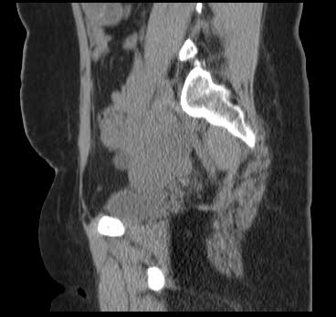 File:Bicornuate uterus (MRI) (Radiopaedia 49206-54296 Sagittal 11).png
