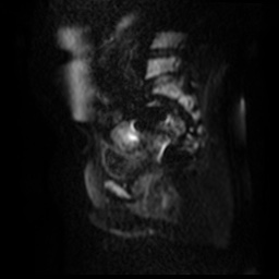 File:Bicornuate uterus (Radiopaedia 51676-57472 Sagittal DWI 37).jpg