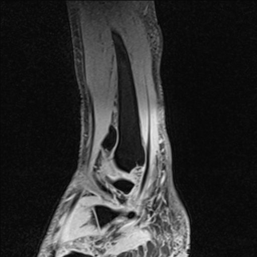 Bilateral Achilles tendon complete tear (Radiopaedia 81344-95051 Sagittal WE - Left 89).jpg