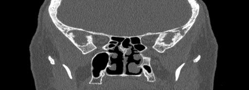 Bilateral Ectopic Infraorbital Nerves (Radiopaedia 49006-54084 Coronal bone window 57).jpg