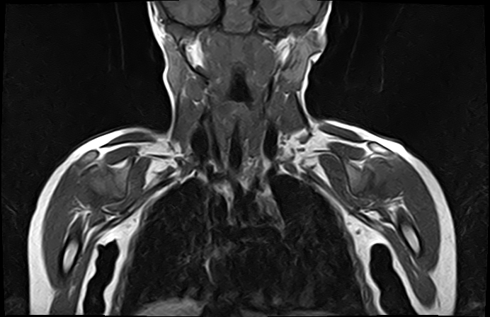 File:Bilateral Sprengel deformity with Klippel-Feil syndrome (Radiopaedia 66395-75650 Coronal T1 10).jpg