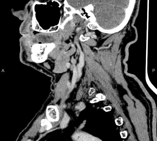 Bilateral Warthin tumors (Radiopaedia 84034-99263 D 52).jpg