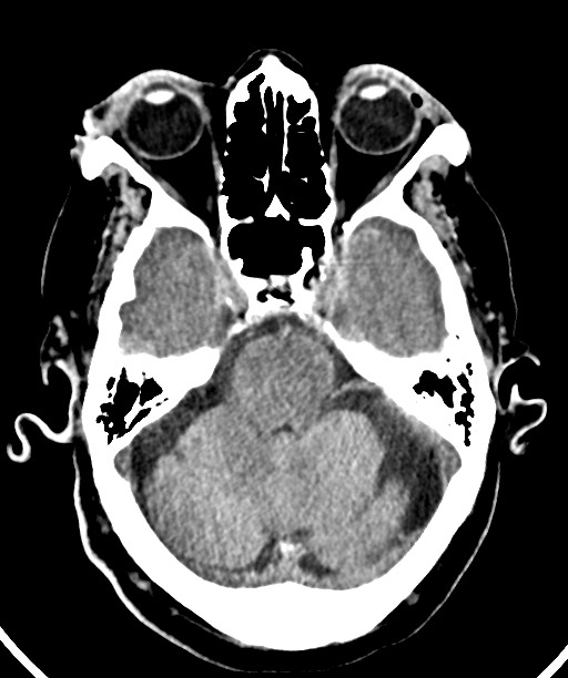 Bilateral acute on chronic subdural hematomas (Radiopaedia 78466-91146 Axial non-contrast 20).jpg