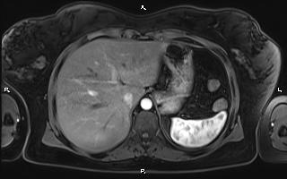 Bilateral adrenal myelolipoma (Radiopaedia 63058-71537 Axial T1 C+ fat sat 23).jpg