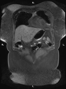 Bilateral adrenal myelolipoma (Radiopaedia 63058-71537 Coronal T1 fat sat 89).jpg