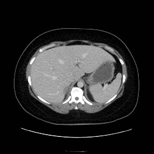 Bilateral adrenal thrombosis (Radiopaedia 58182-65256 A 13).jpg
