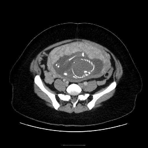 Bilateral adrenal thrombosis (Radiopaedia 58182-65256 A 54).jpg