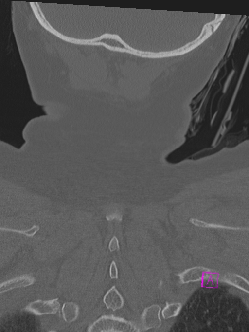 Bilateral atlanto-occipital assimilation (Radiopaedia 28350-28603 Coronal bone window 50).jpg