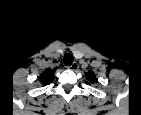 Bilateral carotid body tumors (Radiopaedia 61841-69870 Axial non-contrast 103).jpg