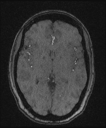 Bilateral carotid body tumors and right glomus jugulare tumor (Radiopaedia 20024-20060 Axial MRA 94).jpg